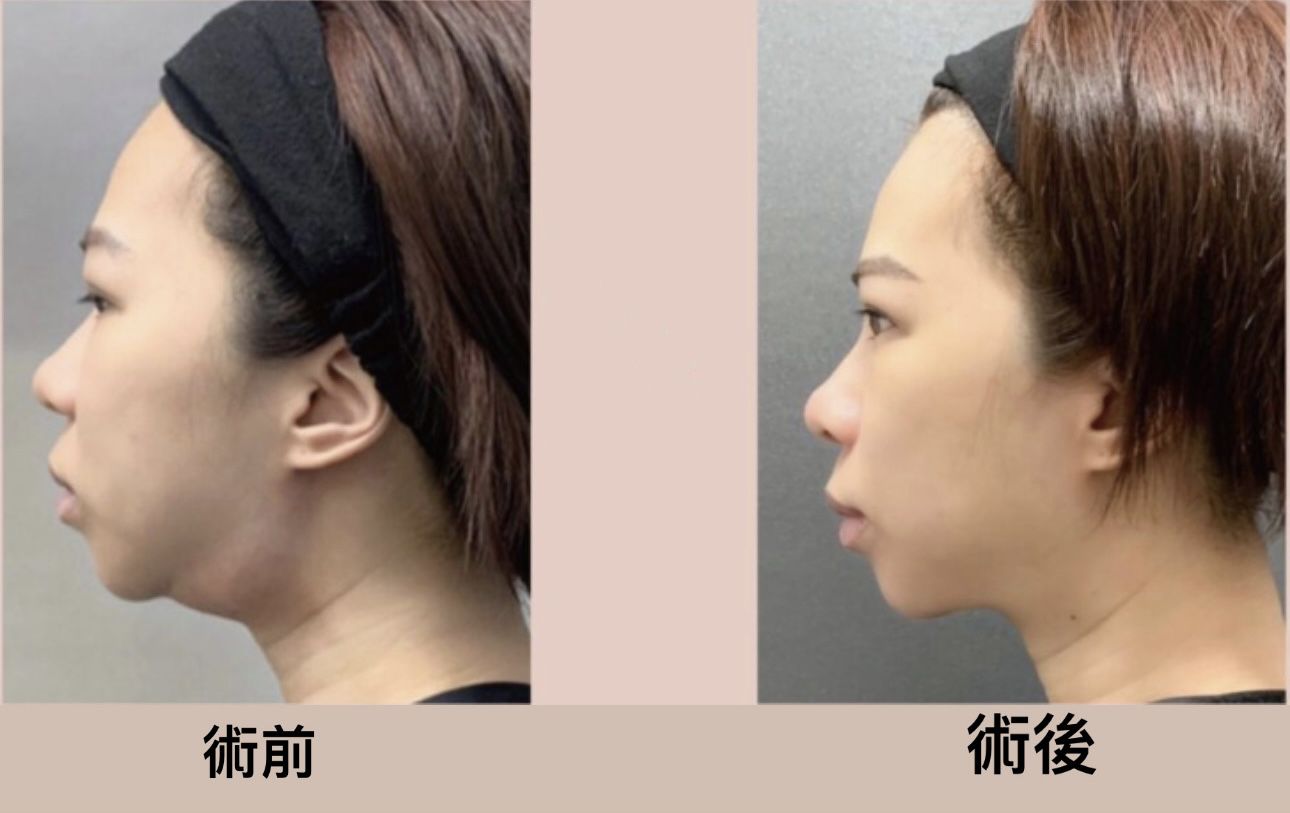 在雙下巴打了Ronkyla容脂針的消脂針心得