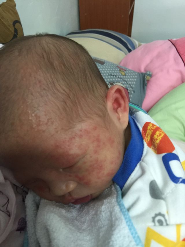 我兒子之前我們給他穿太多整個臉變這樣，其實小孩真的很怕熱，真的沒有所謂的小孩沒有六月天，還是看天氣幫他們穿衣服這樣會比較舒服，後來減少衣服後臉上的熱疹就慢慢退了