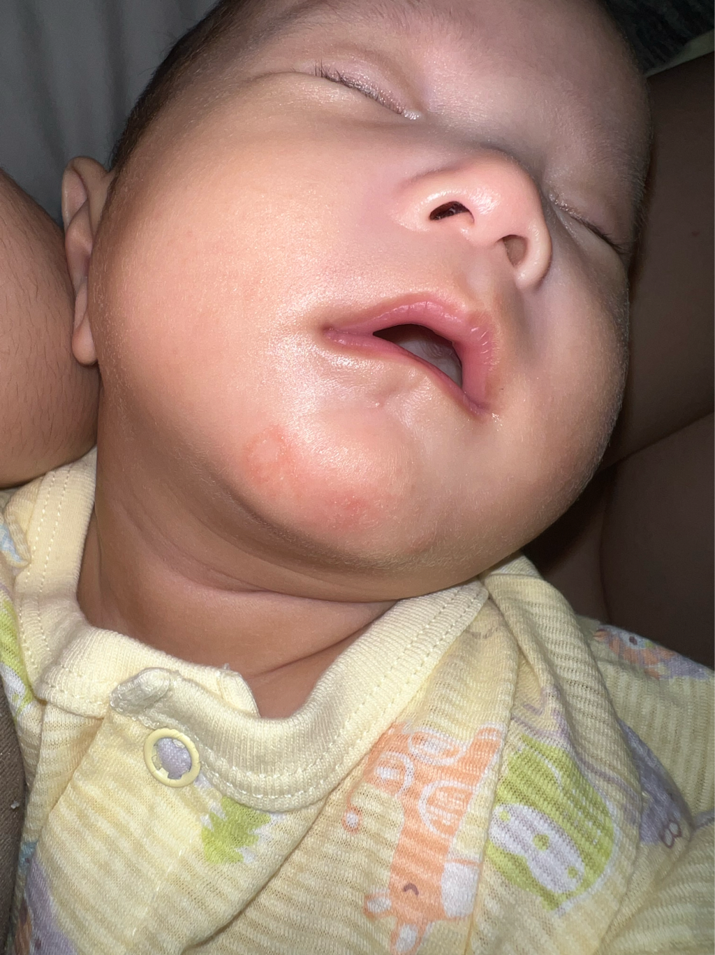 口水疹？還是其他？