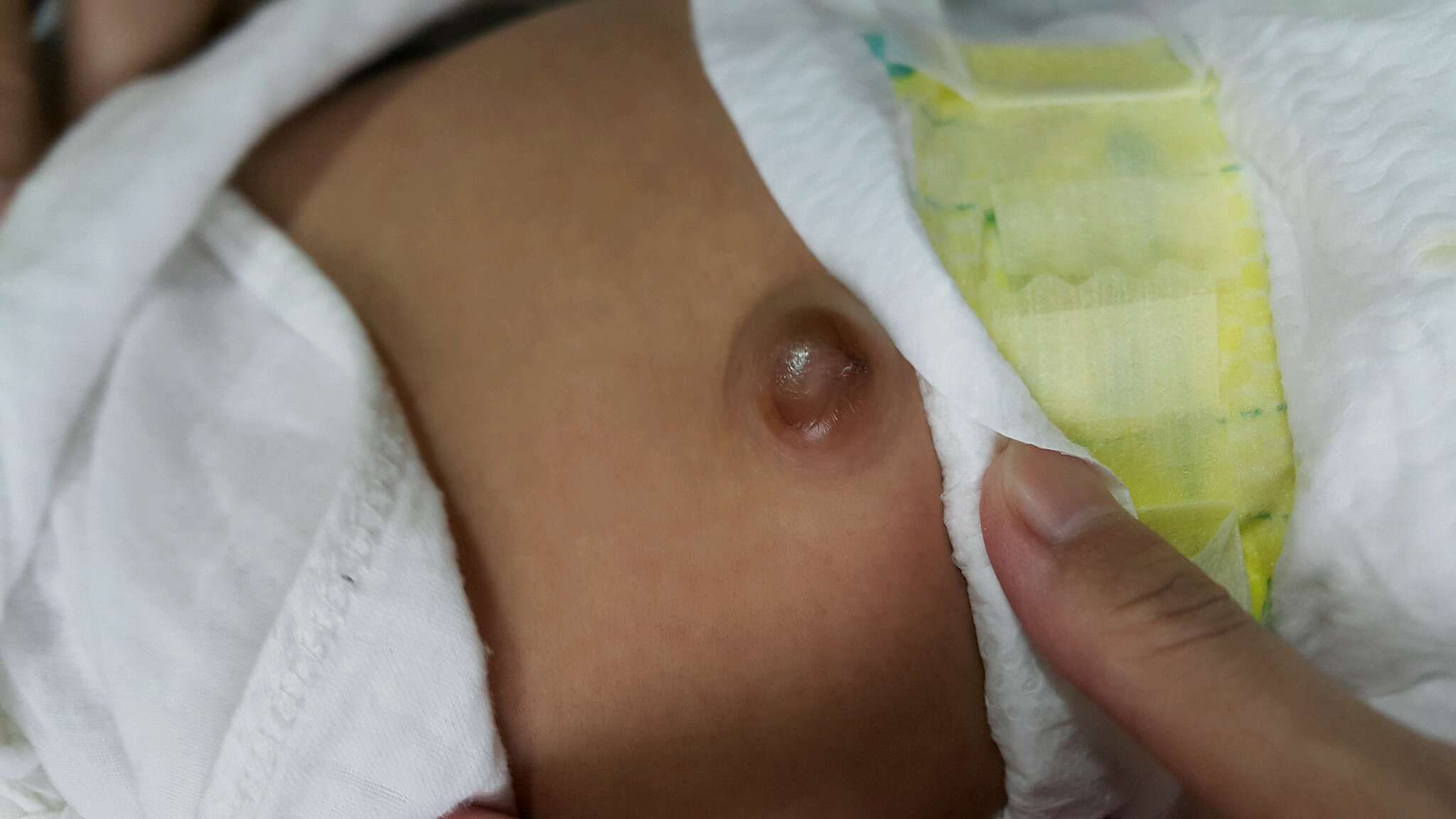 肚臍這樣是正常嗎？