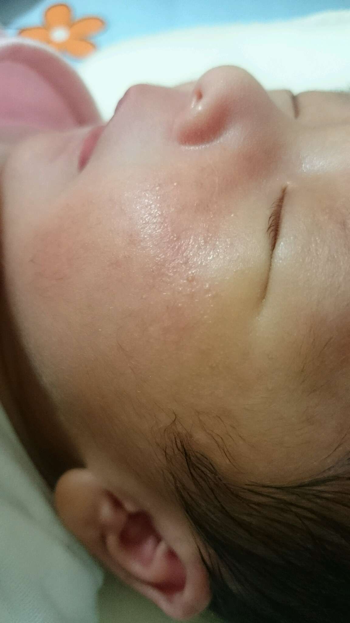 寶寶臉上起疹子