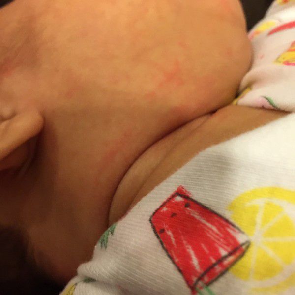 脖子痱子嚴重，怎麼辦？