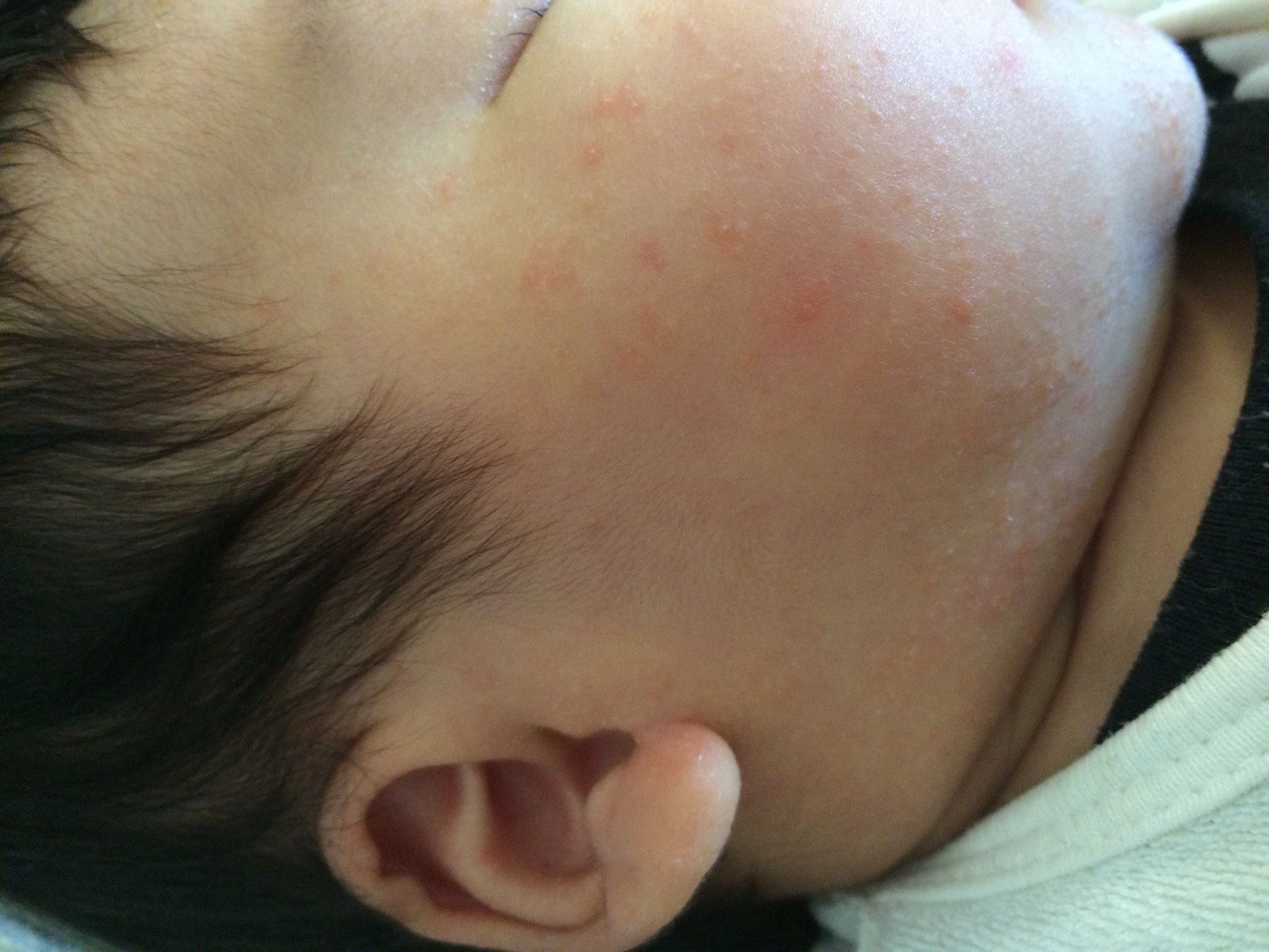 是熱症嗎還是紅斑