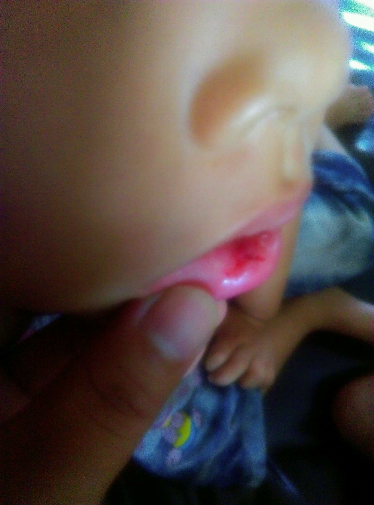 跌倒牙齒撞到嘴唇