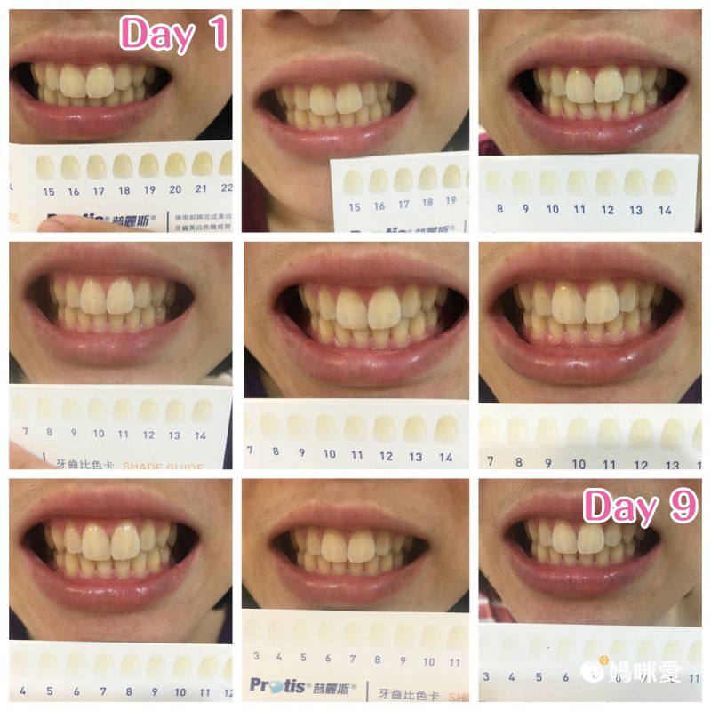 搶救黃牙必用【Protis 普麗斯】深層牙齒美白 牙托/貼片