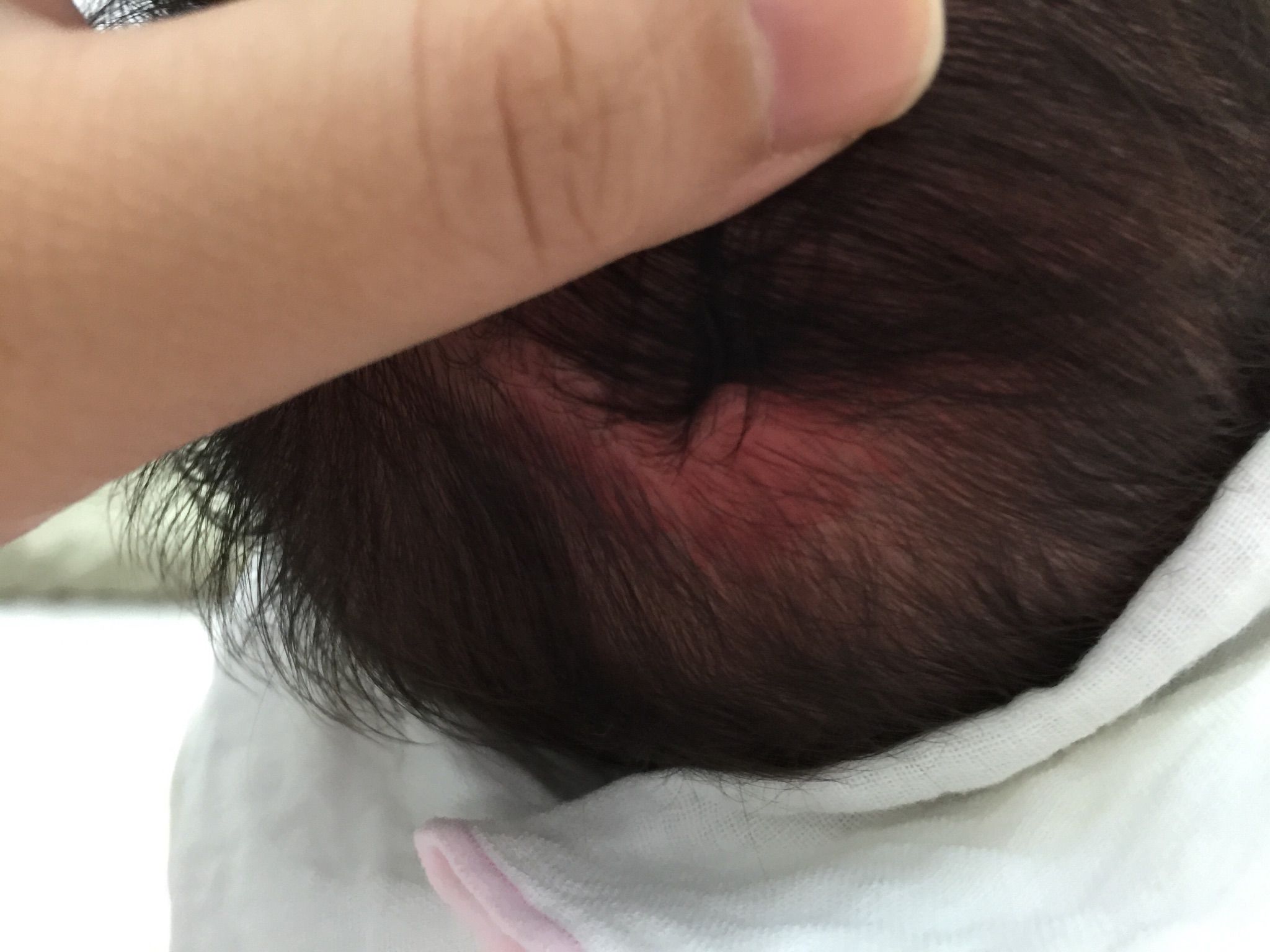 後腦勺有一塊紅紅的