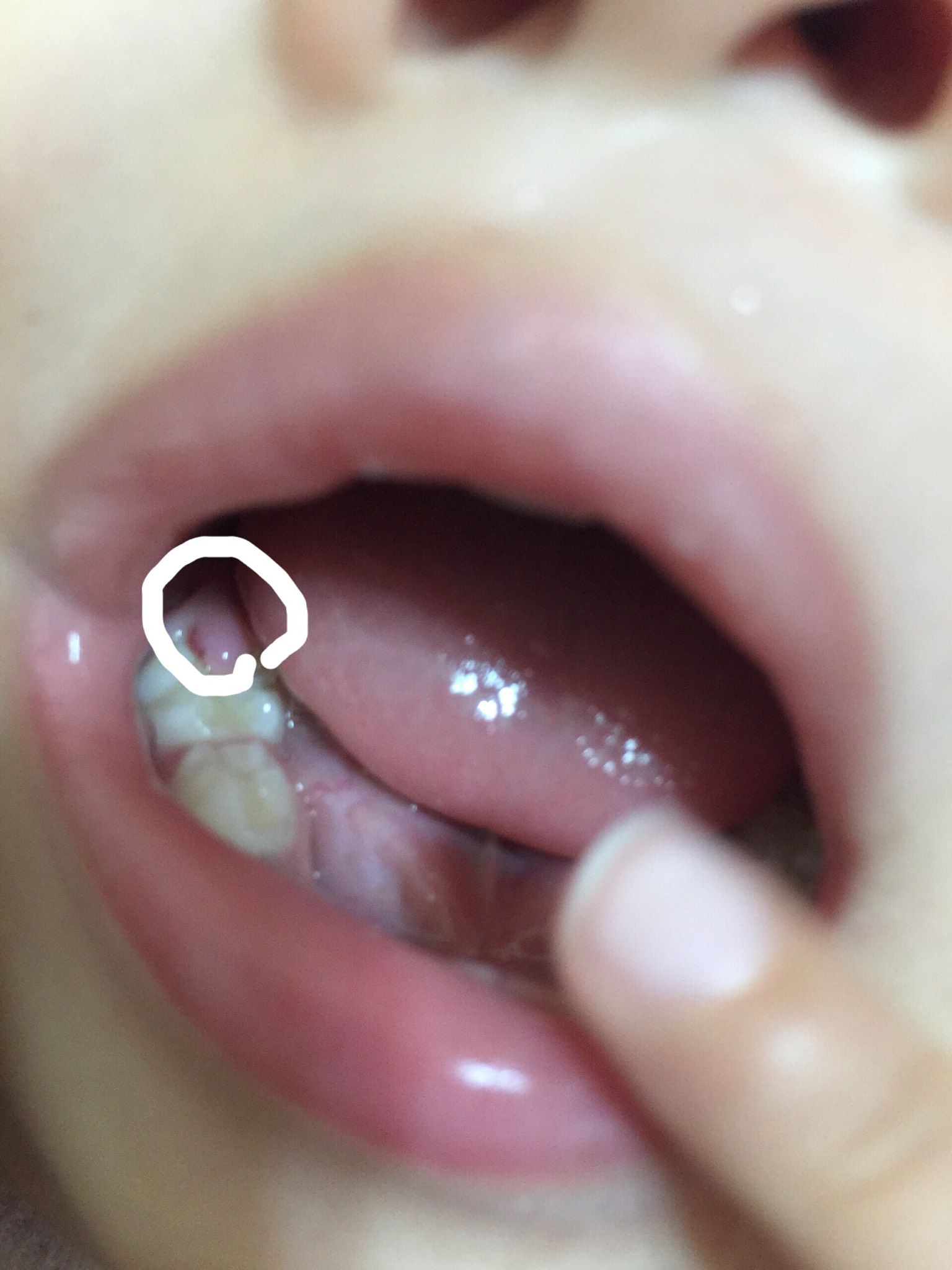 兩歲下排已長10顆牙，最近還會再長嗎？