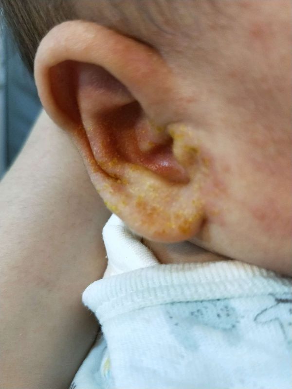 脂漏性皮膚炎 媽咪愛 育兒問答