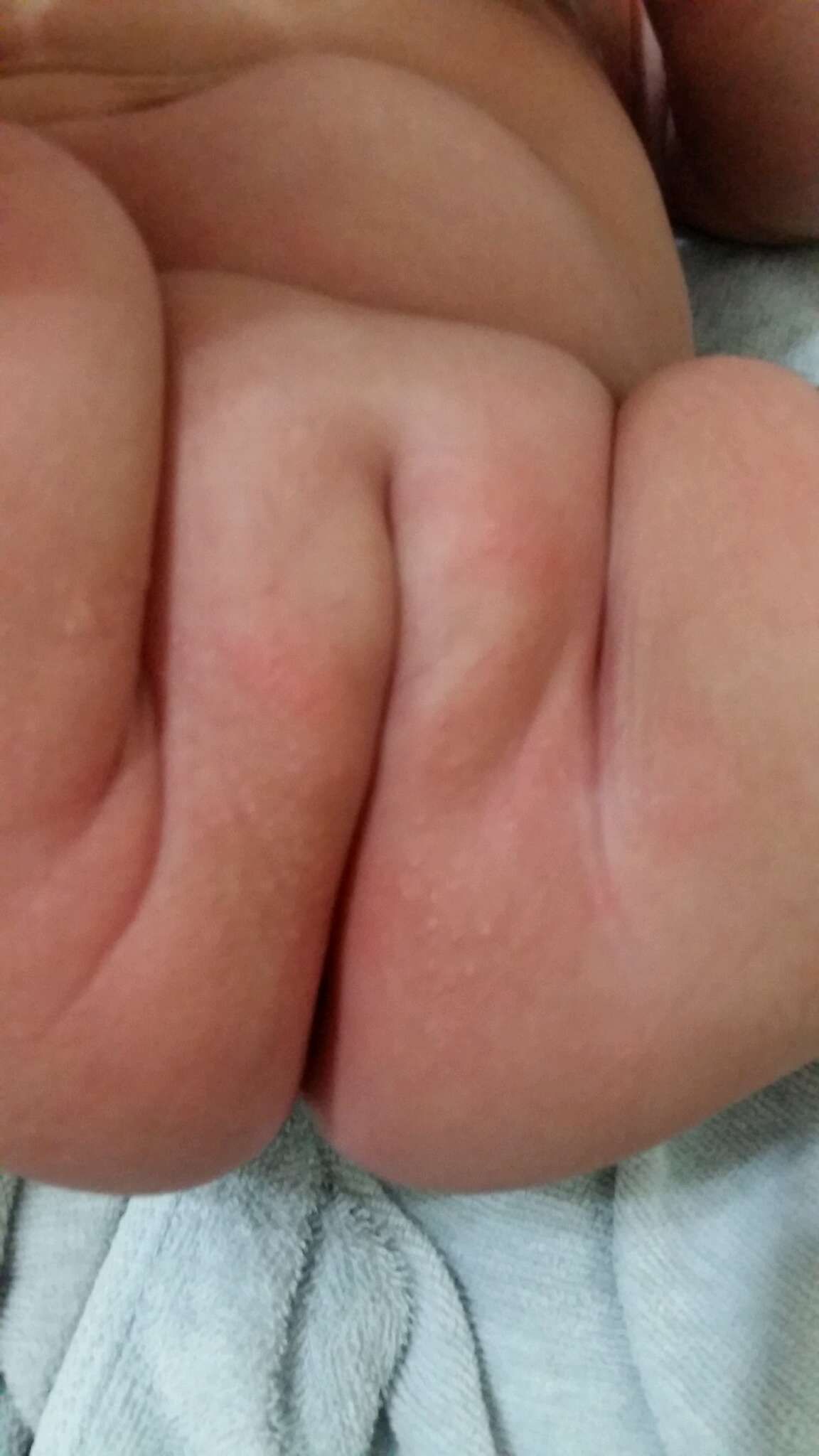 （跪求）這是異位性皮膚炎？還是尿布疹？