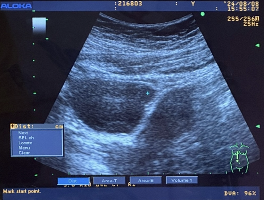 哪一個才是胎囊跟胚胎啊