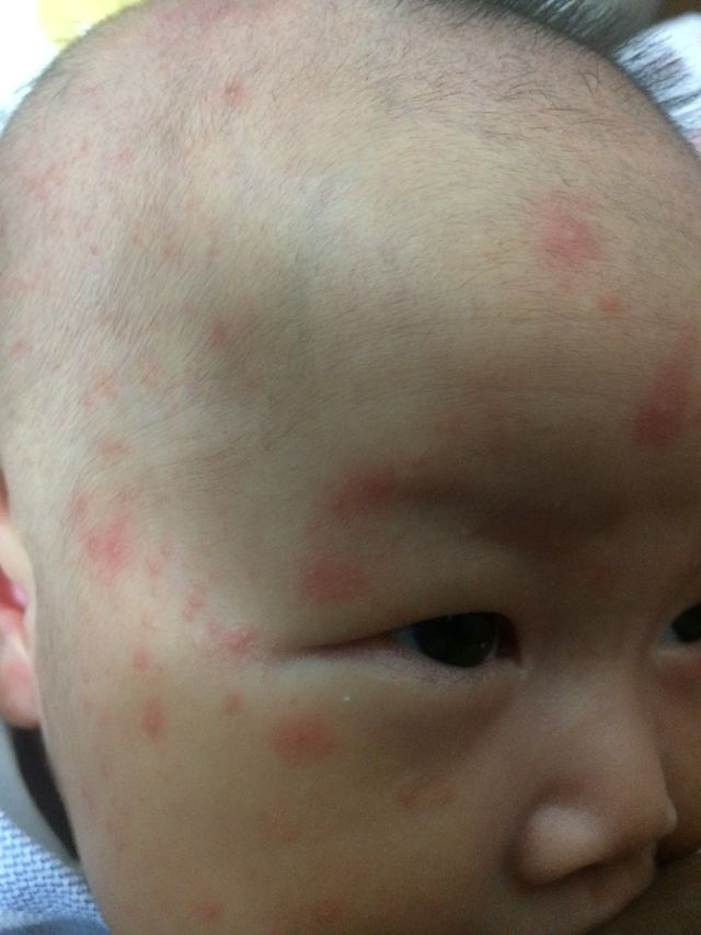 那請問各位媽媽我們家妹妹皮膚這樣擦你們推薦的護膚霜也會改善嗎？明天想帶去給醫生看了⋯因為長的太多很嚴重！如果可以不擦藥是最好～