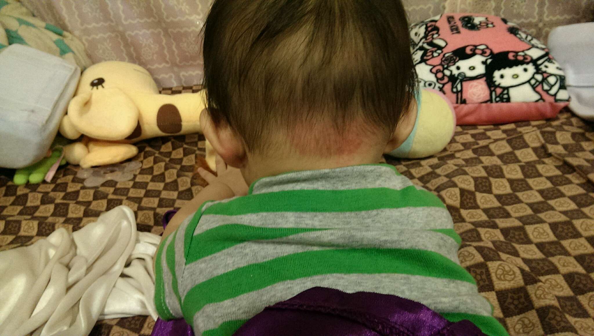 請問是濕疹還是鮭魚斑？