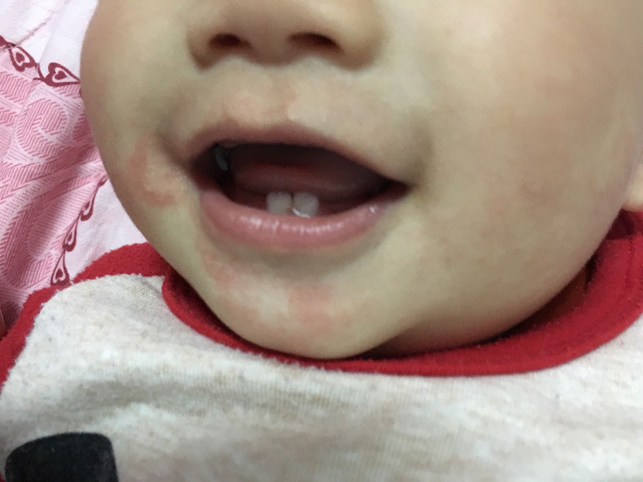 寶寶嘴角是濕疹嗎？