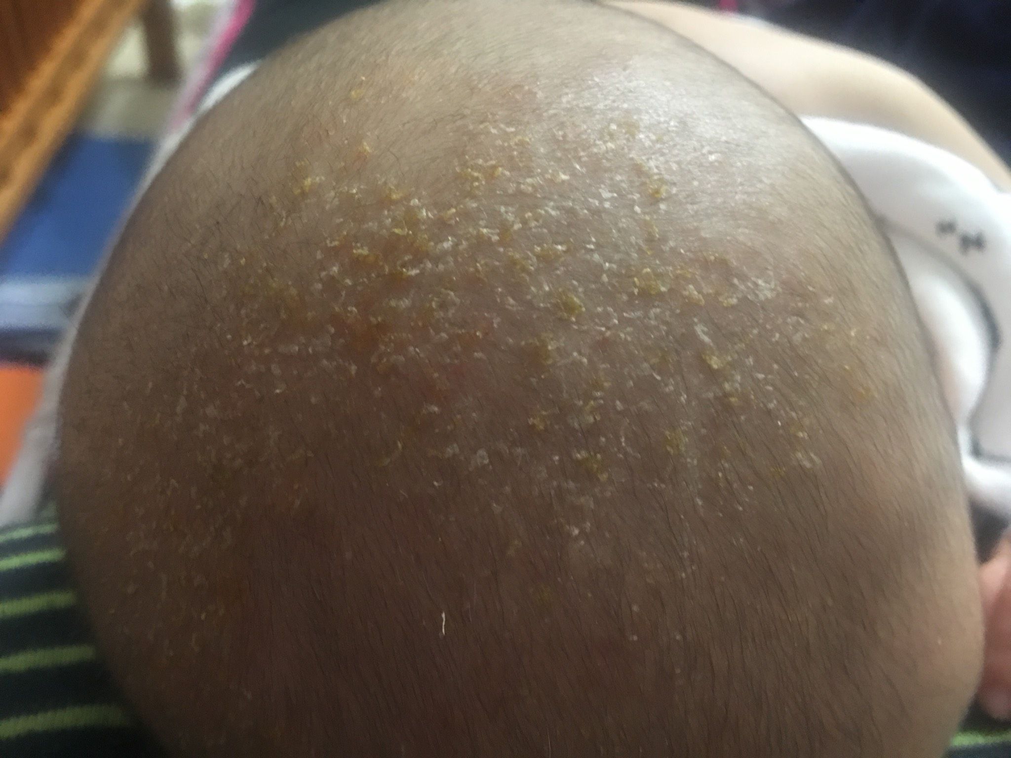 請問頭皮有黃黃的結痂物跟皮屑怎麼處理？