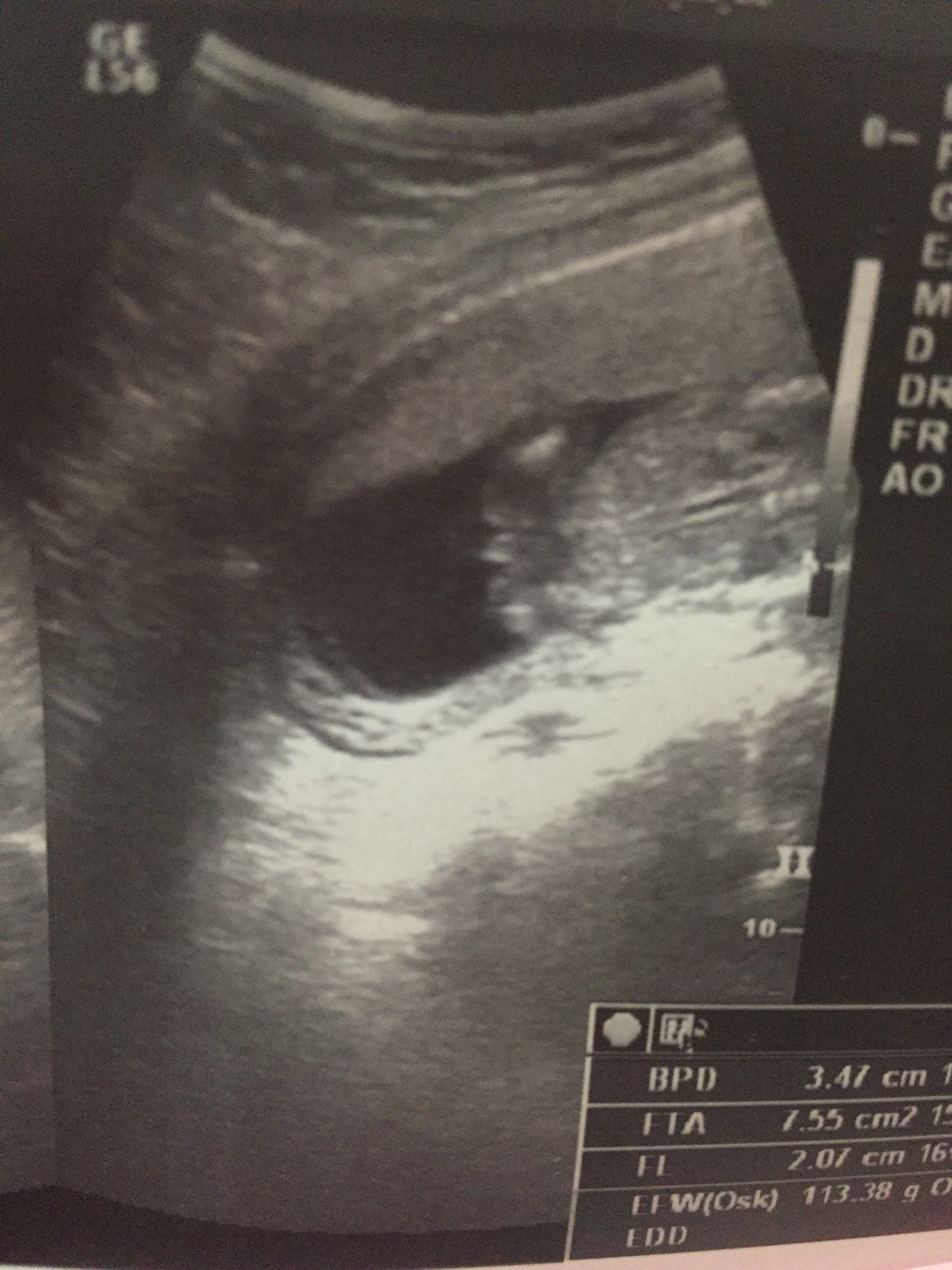 寶寶怎麼分三條線還是白點（男女）