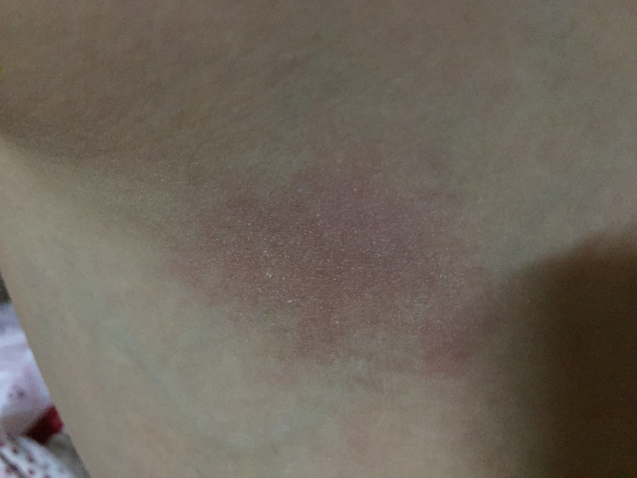 乳腺炎的前兆？