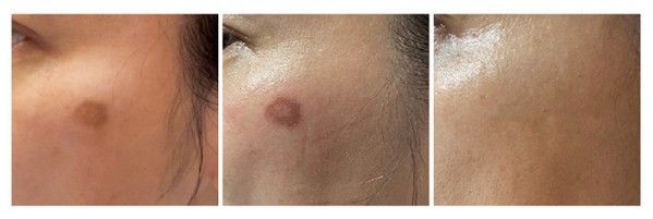 我的皮秒雷射除班紀錄分享~