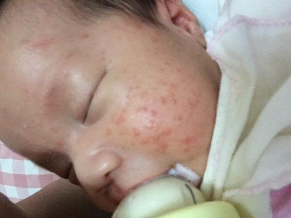 寶寶皮膚長有膿的痘痘