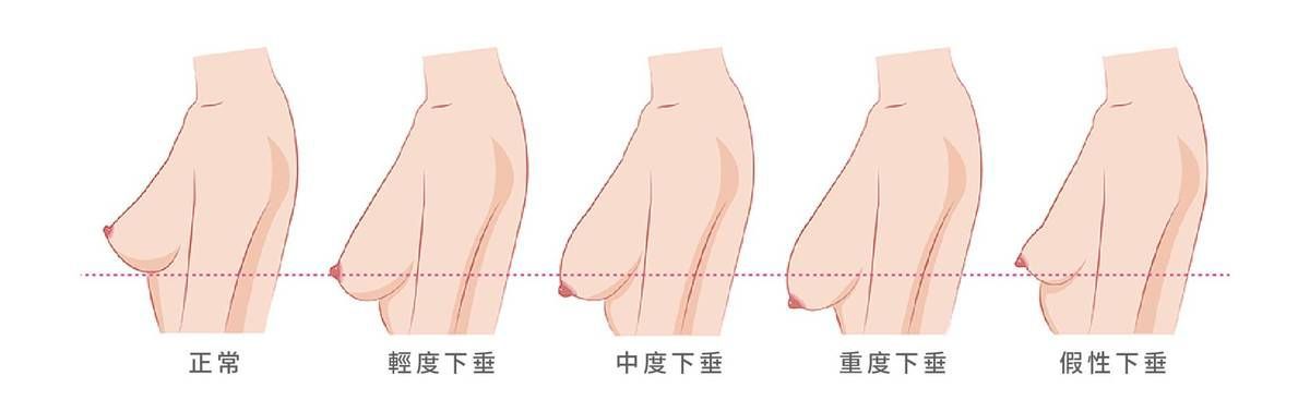 垂奶有救嗎?拯救乳房大作戰!