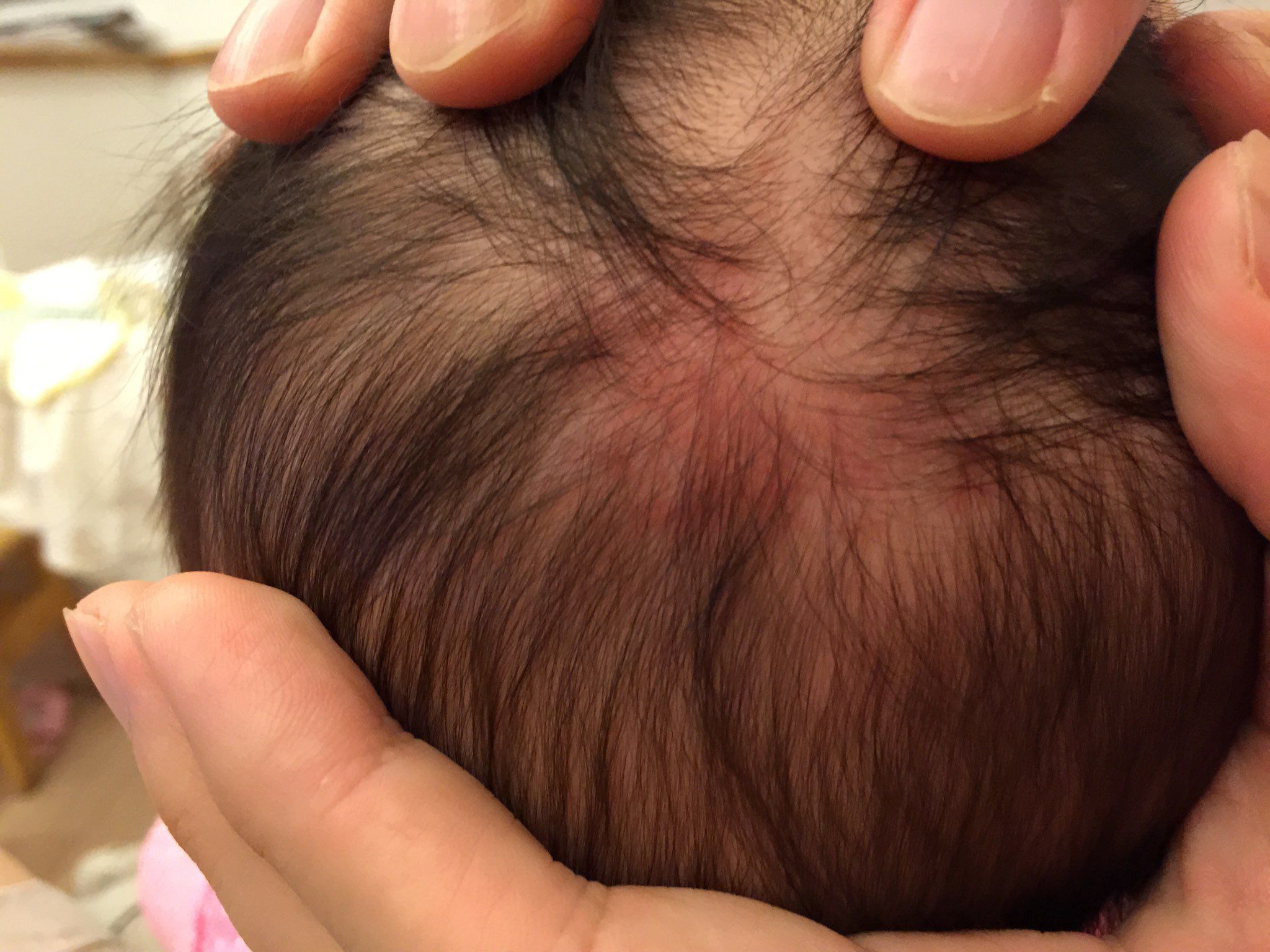 寶寶後腦勺紅紅的