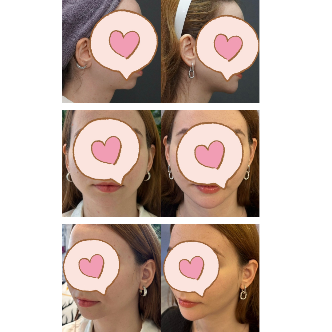 #分享 玻尿酸拯救了我短縮的下巴💗