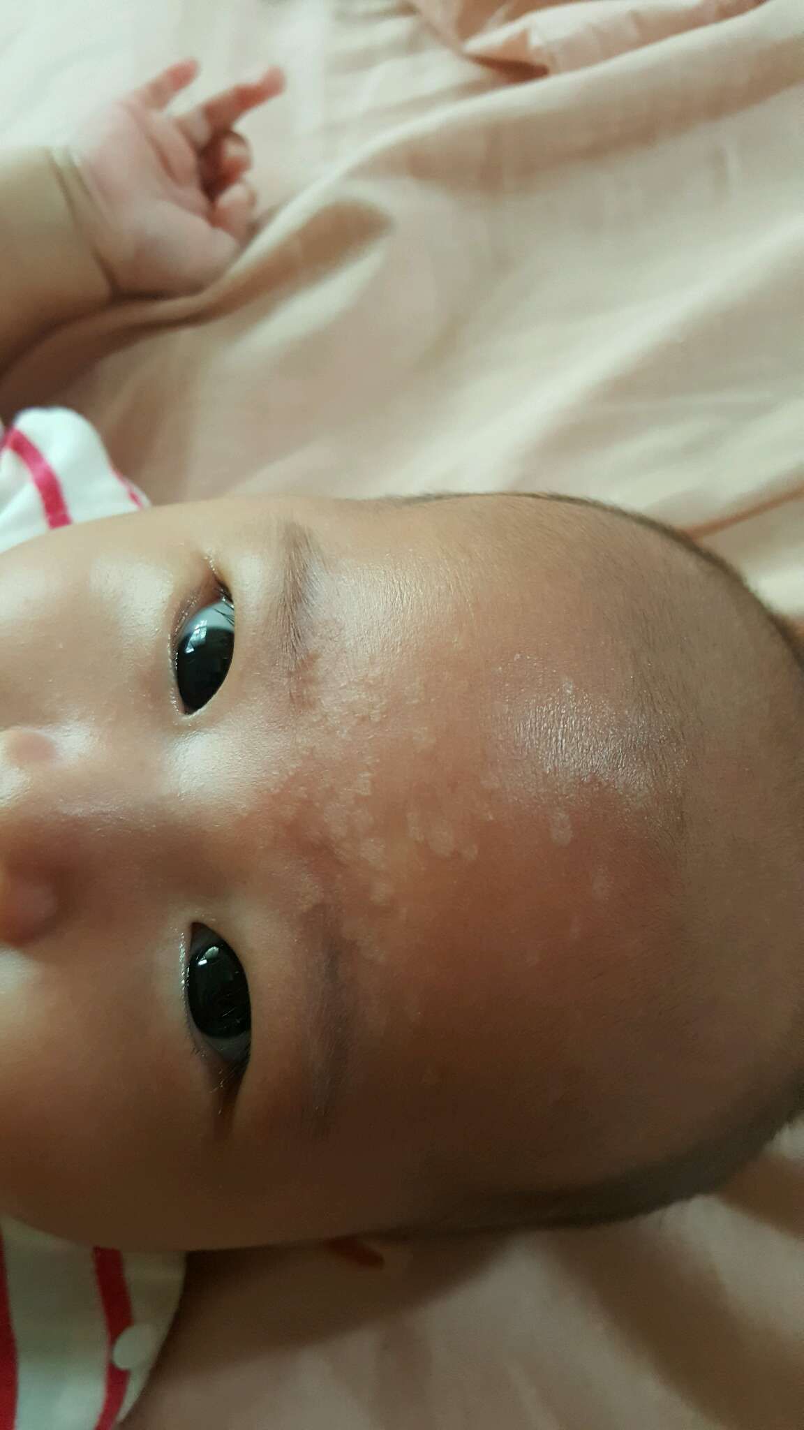 額頭上的小白斑