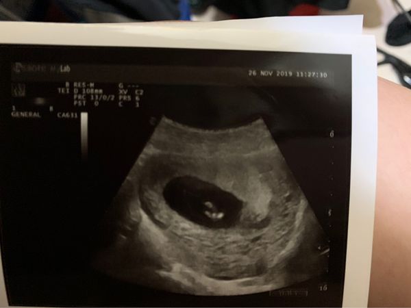 12週寶寶性別區分 媽咪愛 育兒問答