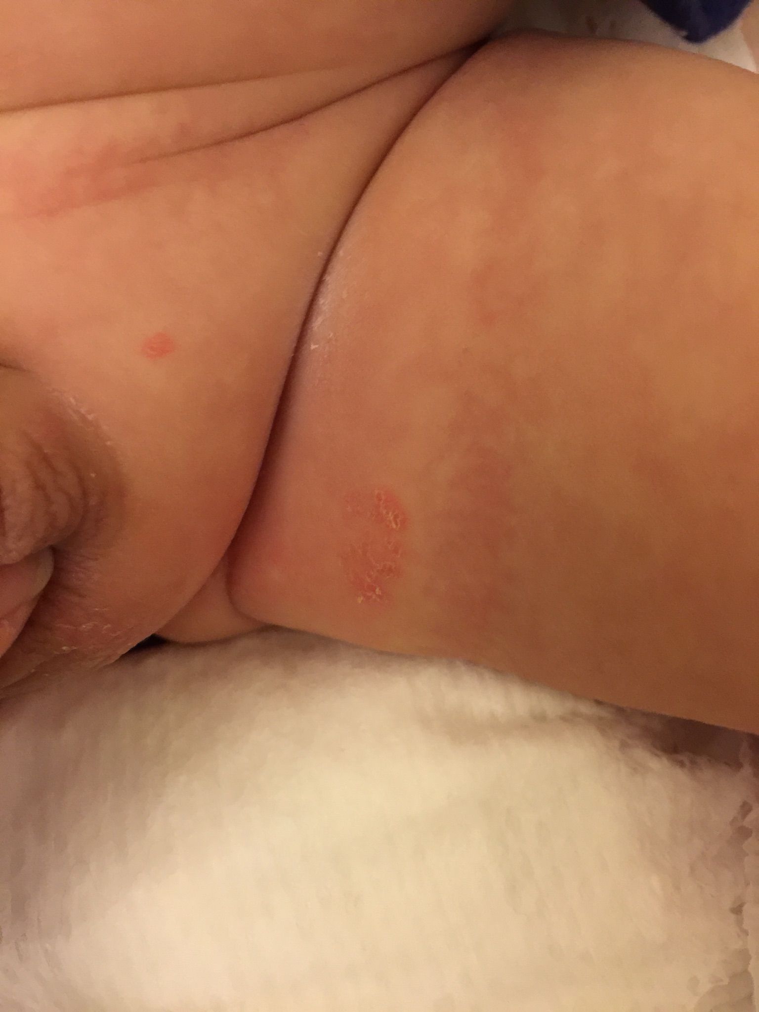 寶寶跨下大腿附近破皮