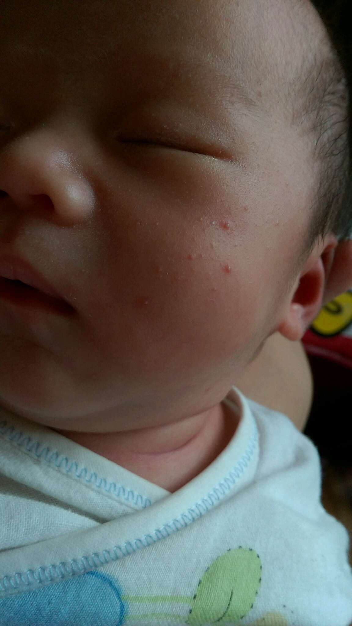 寶寶臉上長這是什麼?