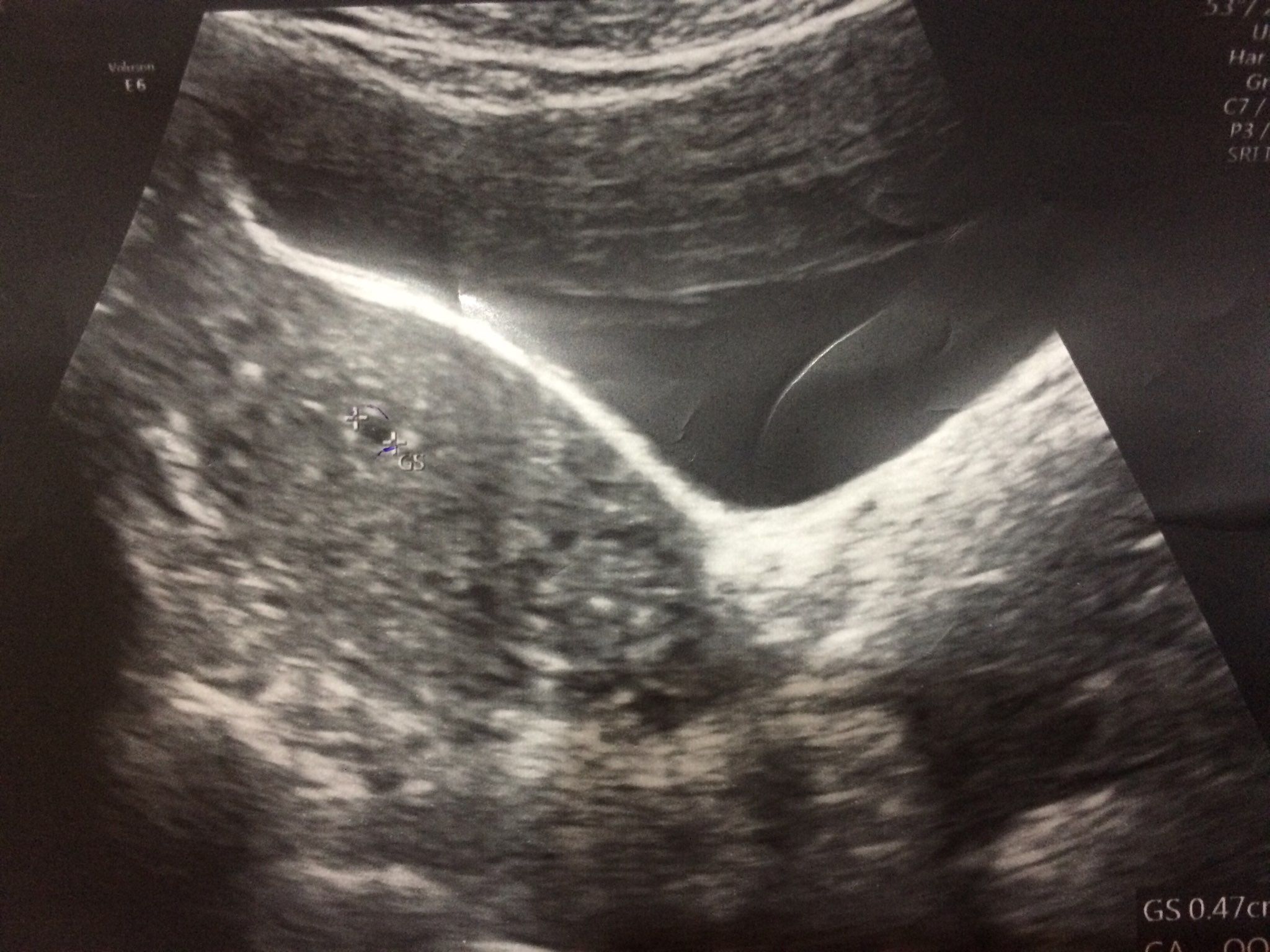 懷孕5週 太小 媽咪愛 育兒問答