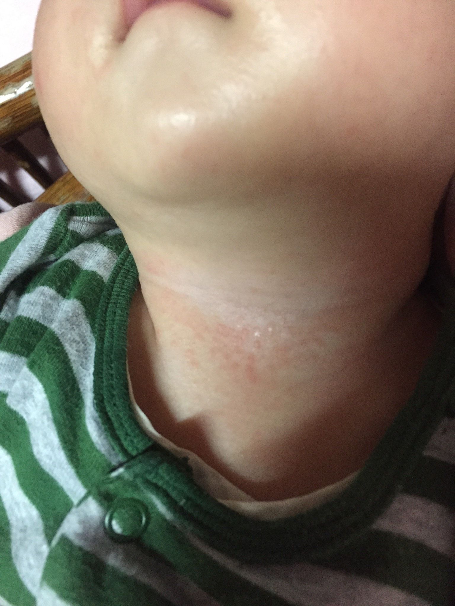 請問脖子疹子可能原因