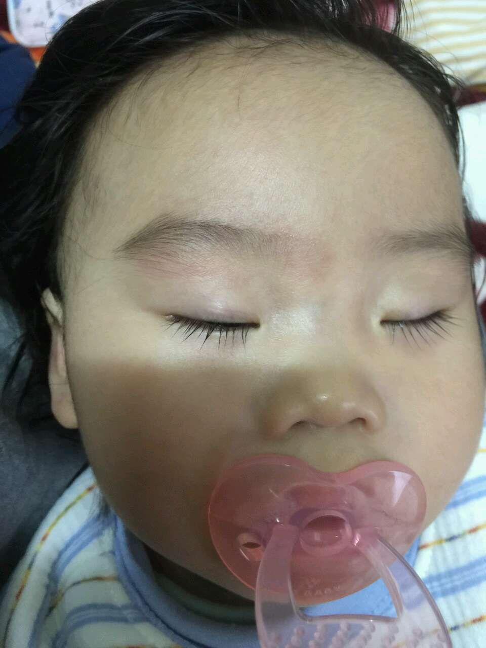 請問照片的眉毛紅紅，是過敏嗎？