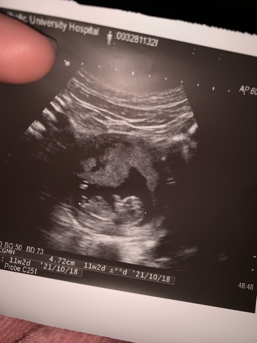 照超音波11週3天