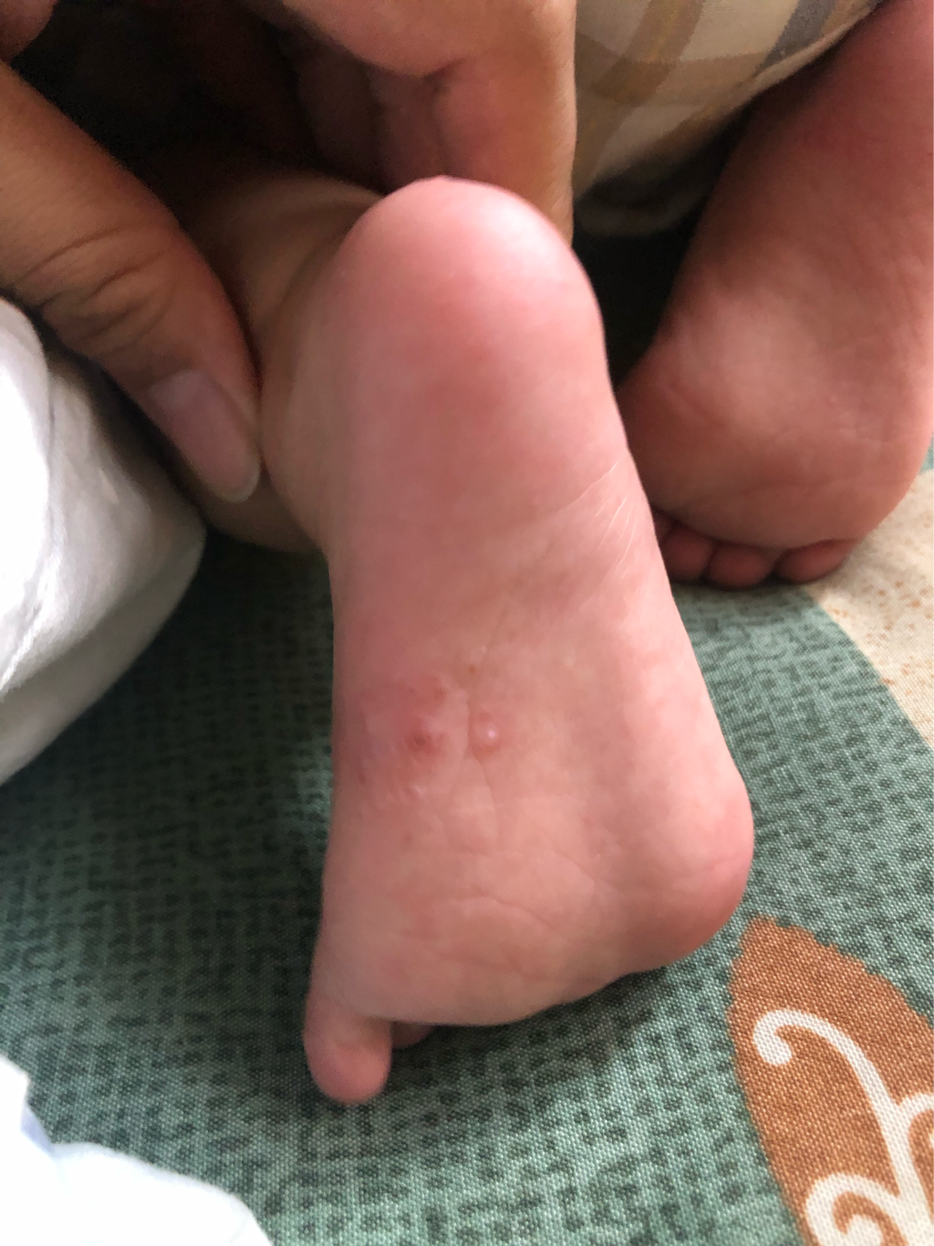 寶寶腳上長水泡