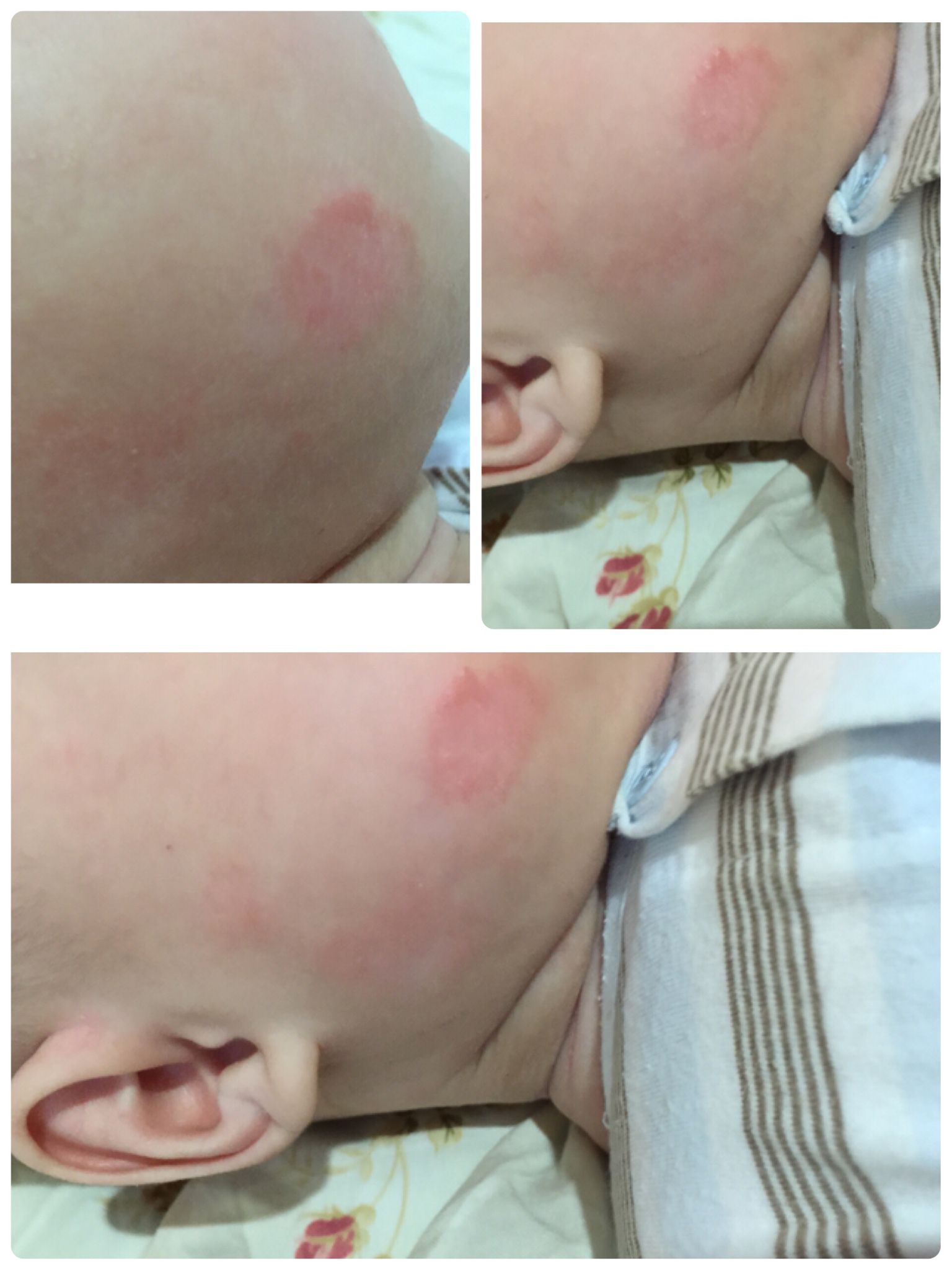 寶寶臉上長ㄧ塊塊紅疹