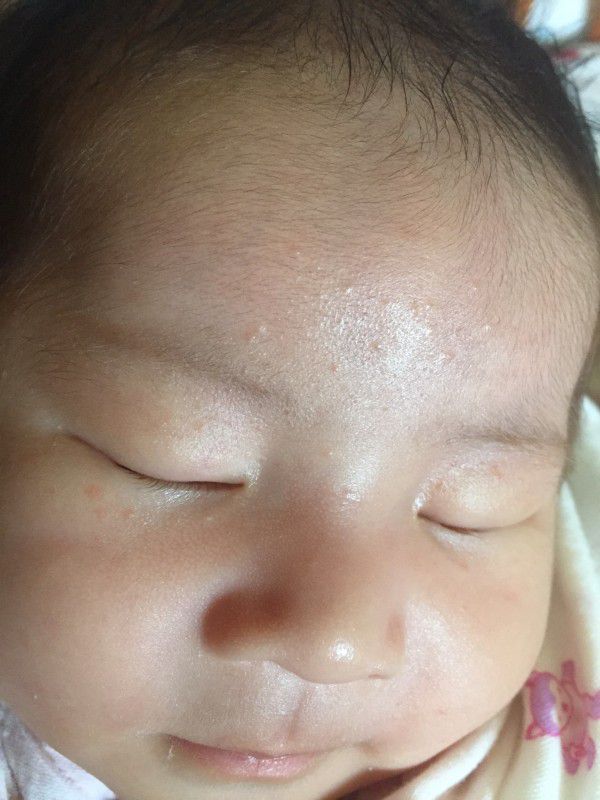 21天的寶寶臉上長小豆豆