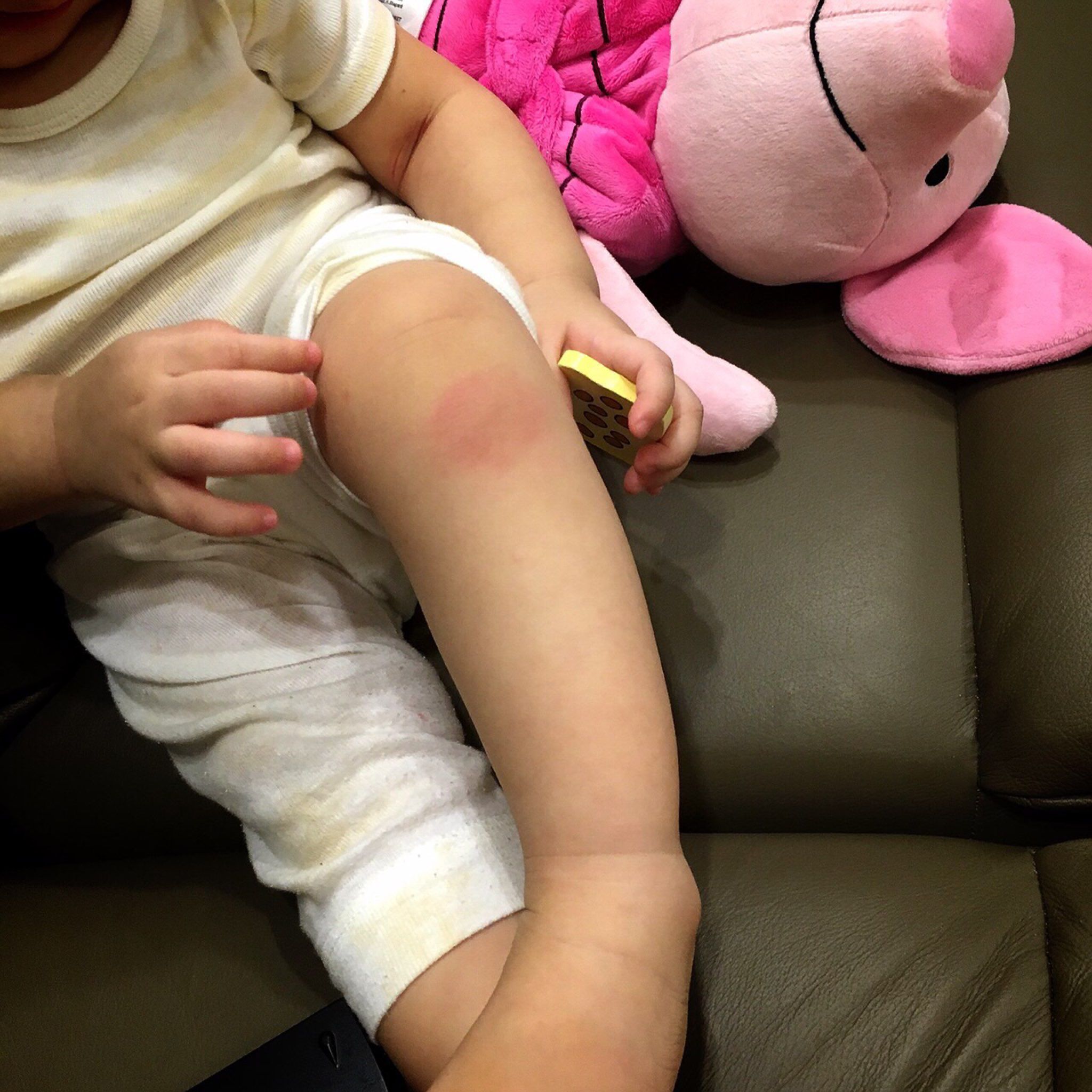 寶寶膝蓋下方紅腫ㄧ塊？有圖