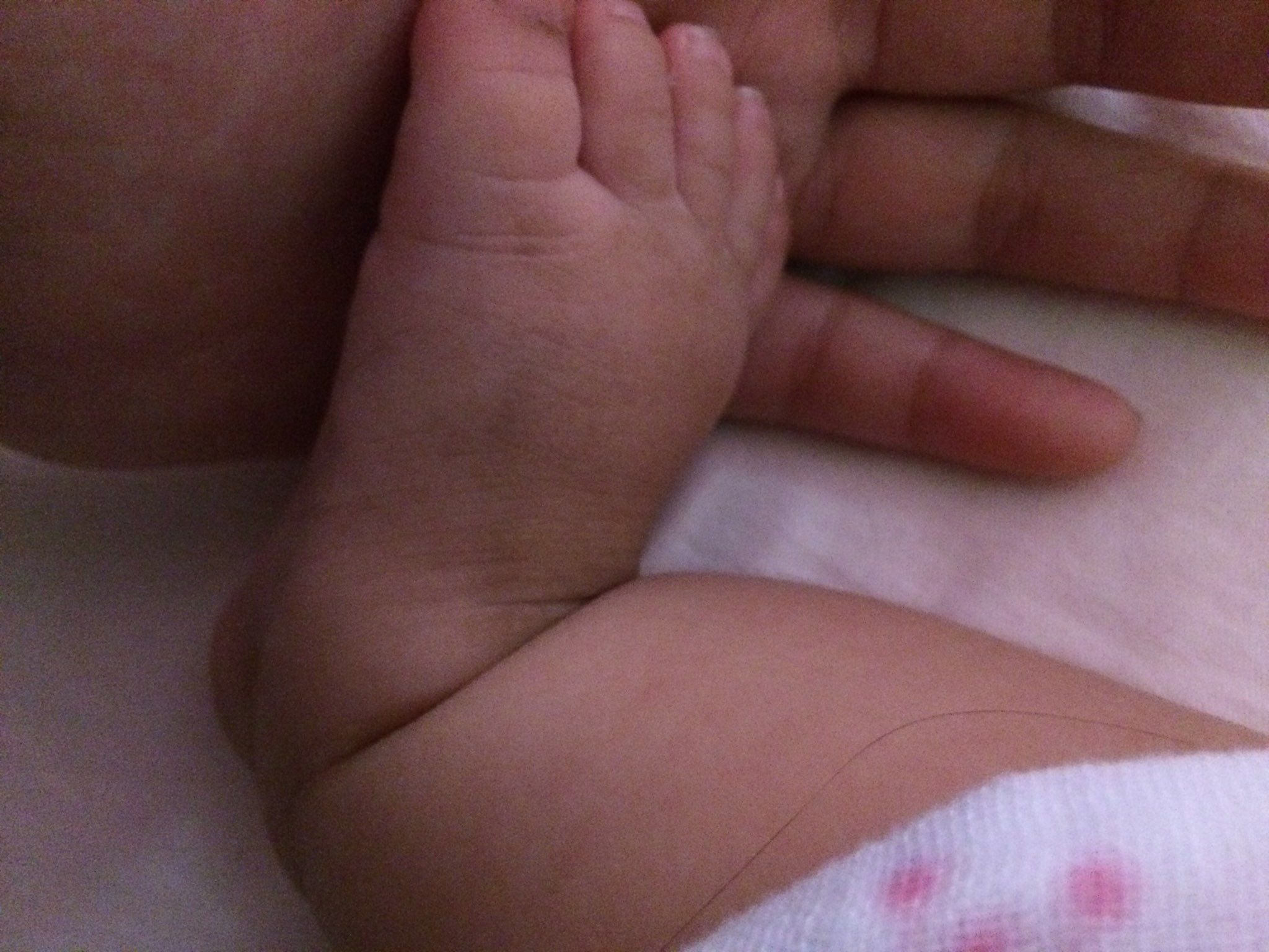 寶寶腳背粗粗黑黑的