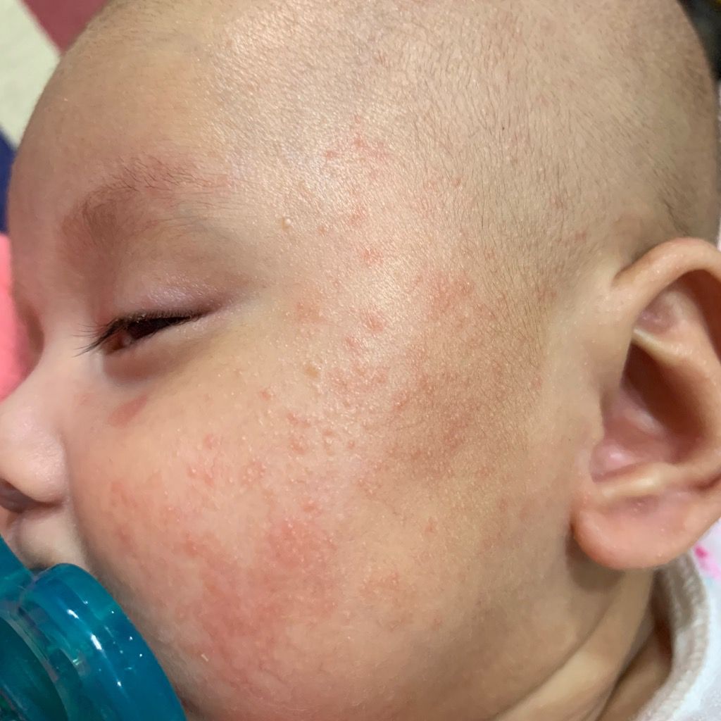 寶寶臉上反覆的紅疹