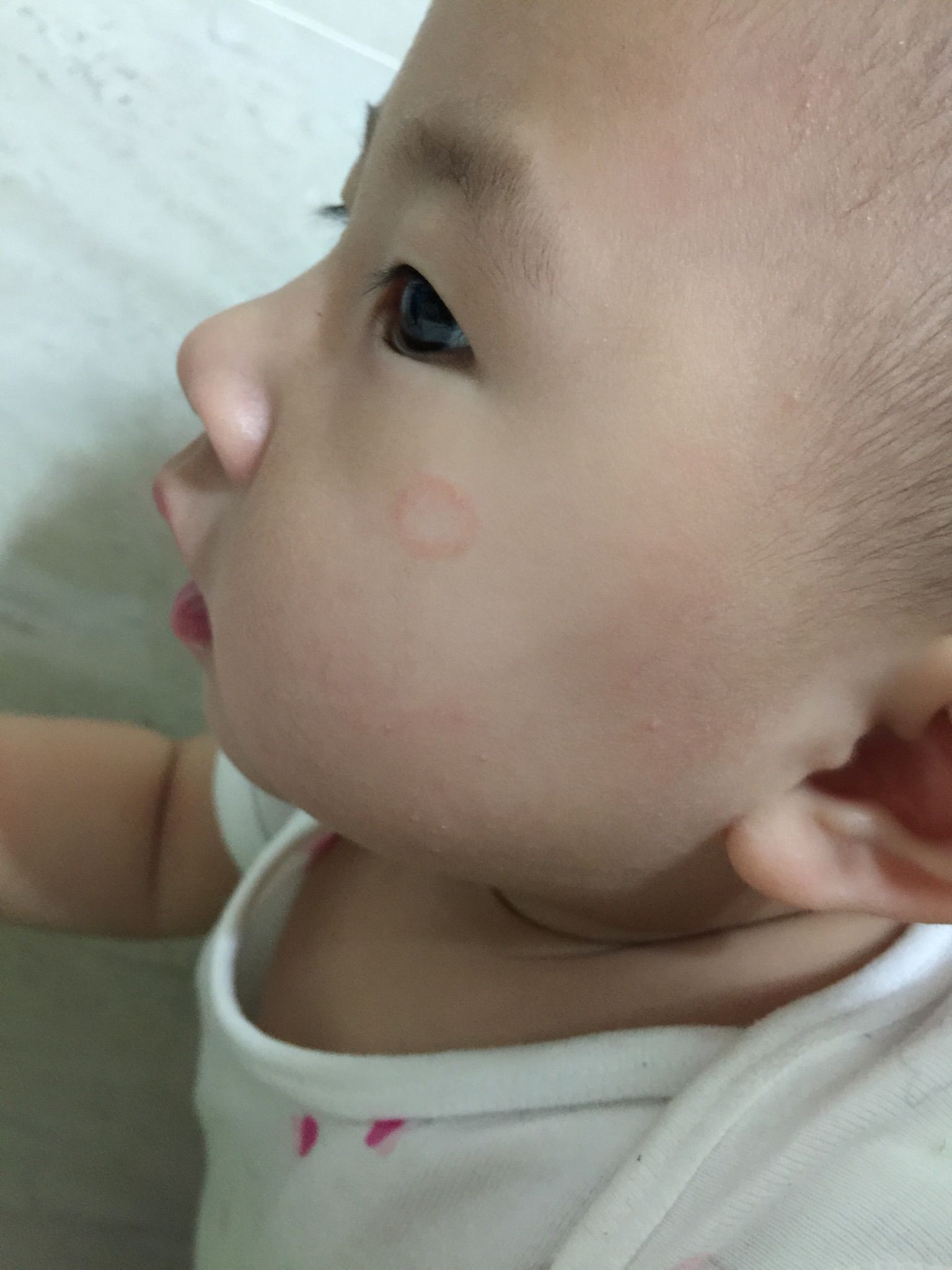 臉上紅點
