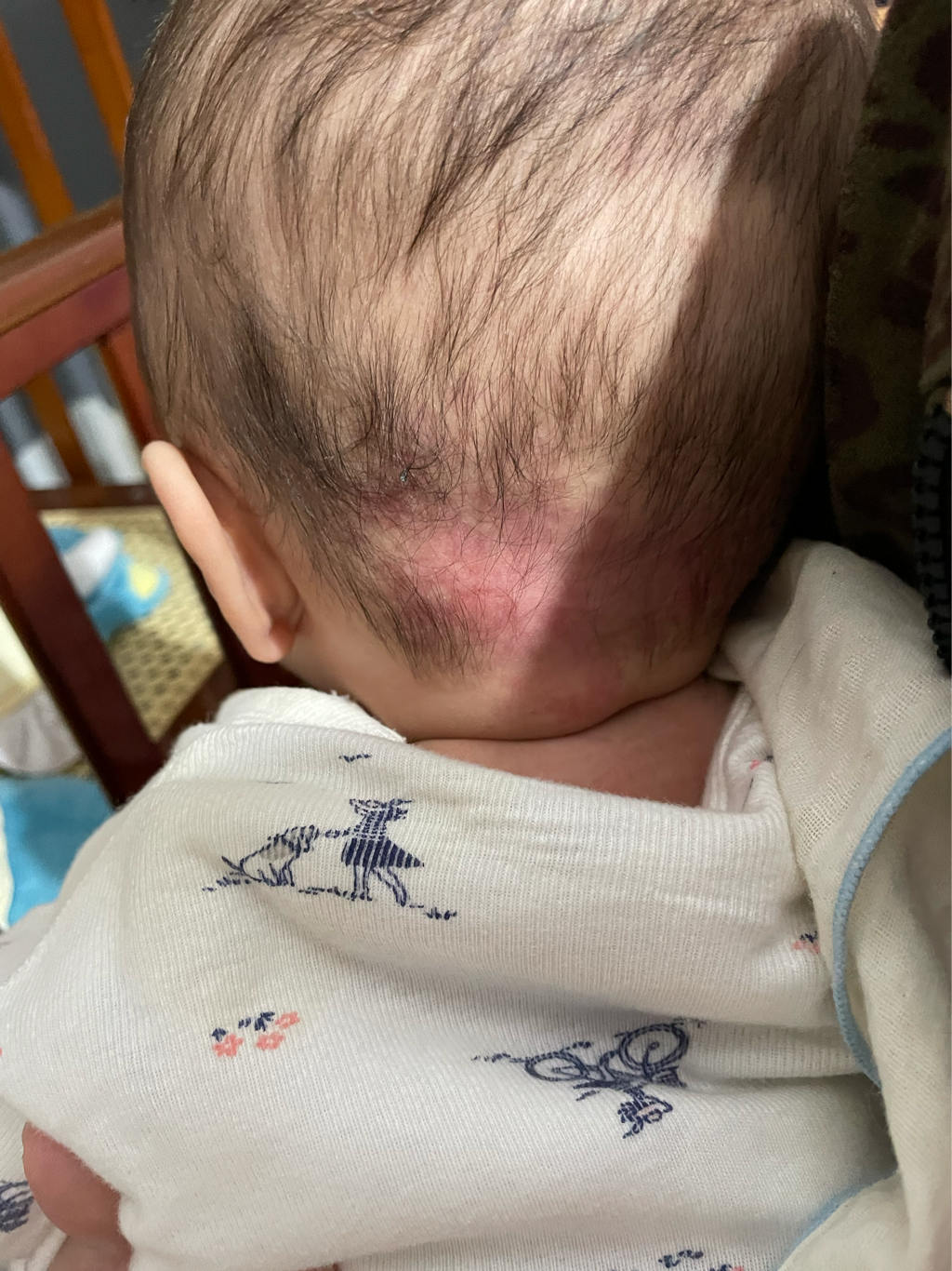 為什麼四個月寶寶頭部後方掉了頭髮…