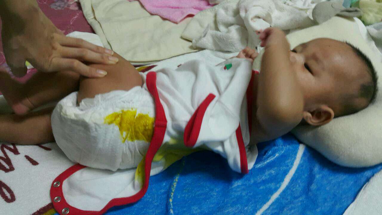 老是溢屎，是尿布不合身？還是包法不對？