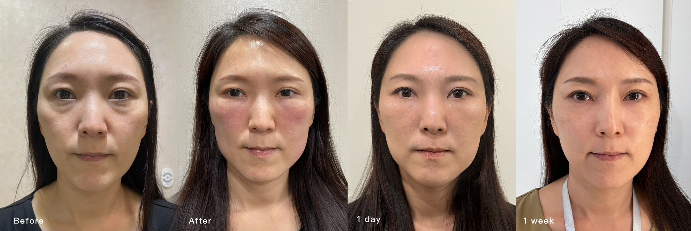 困擾眼袋黑眼圈用妮芙蕾澎怦針