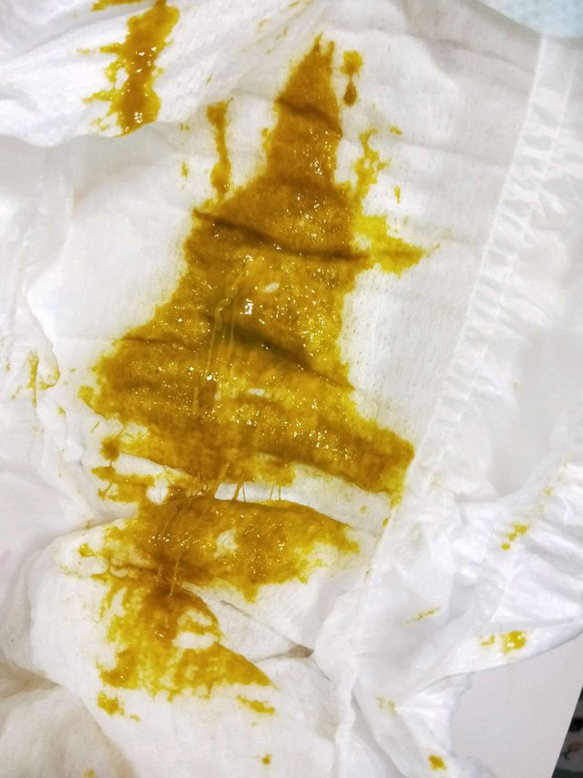 這個裡面就是有粘液，腸胃炎