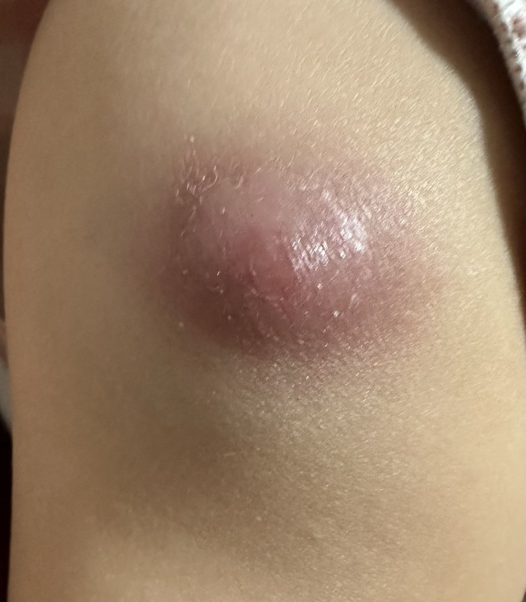 卡介苗施打後8週後腫起來