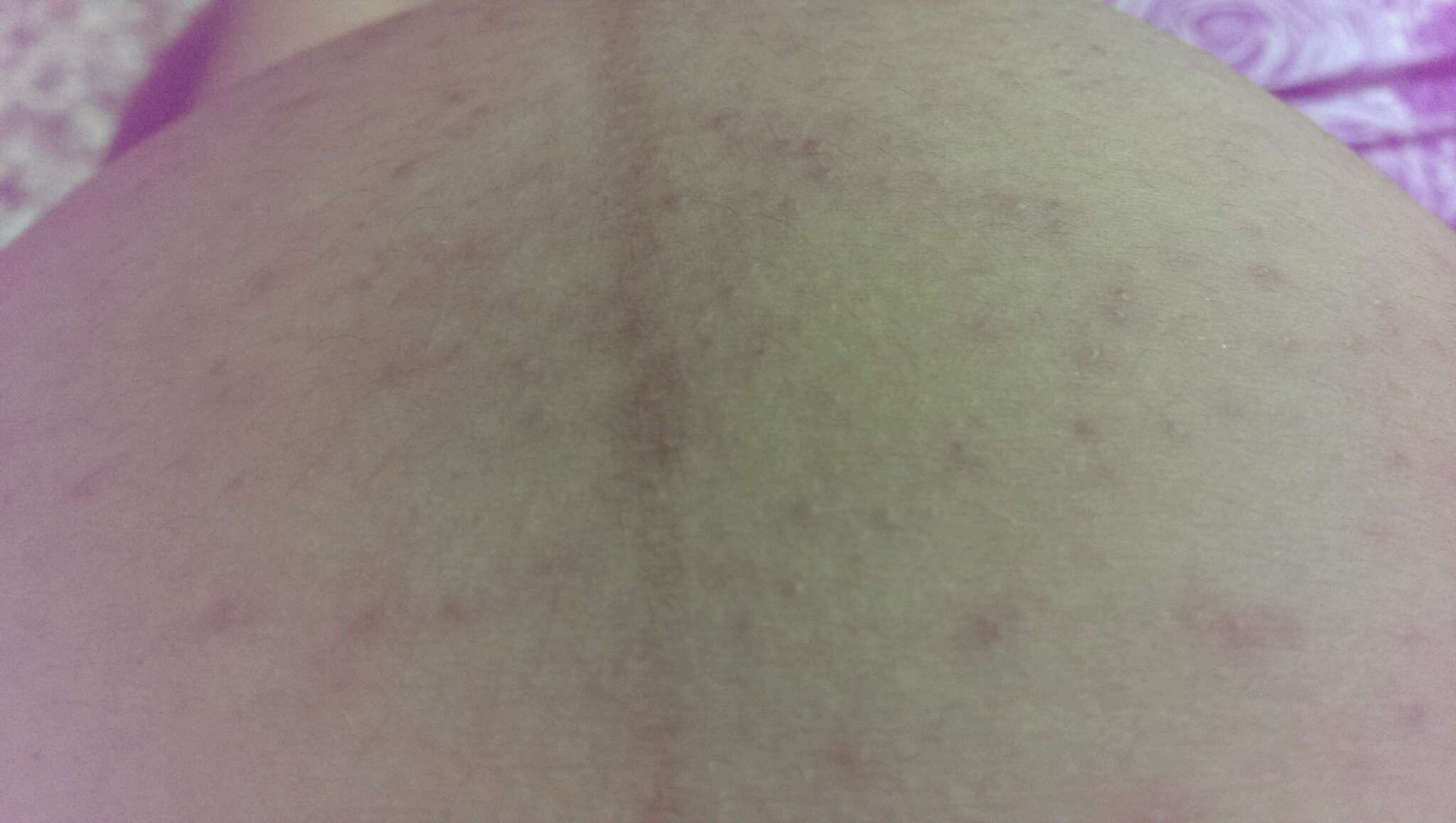 手腳肚子出現紅疹