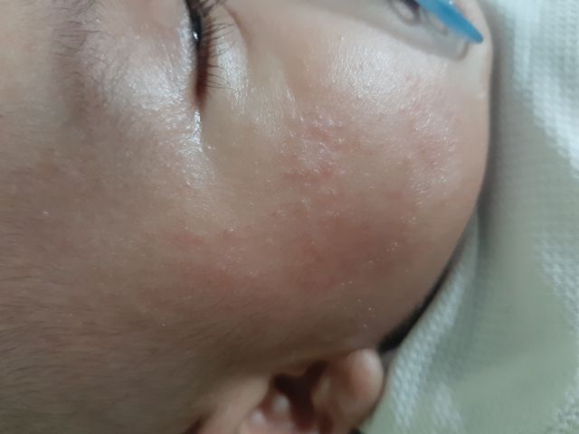 我家寶寶也是頭跟臉都是而且會癢的感覺我家寶寶會一直想要抓看了好心疼又好不舒服真不知道該如何是好我前兩胎寶寶沒遇過這樣