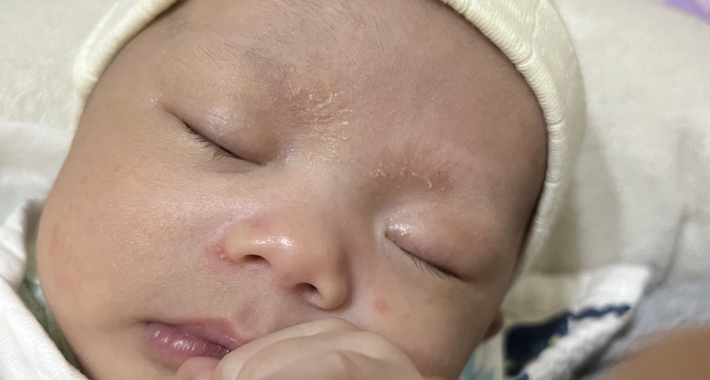 1m大 寶寶眉毛像脫皮一樣⋯