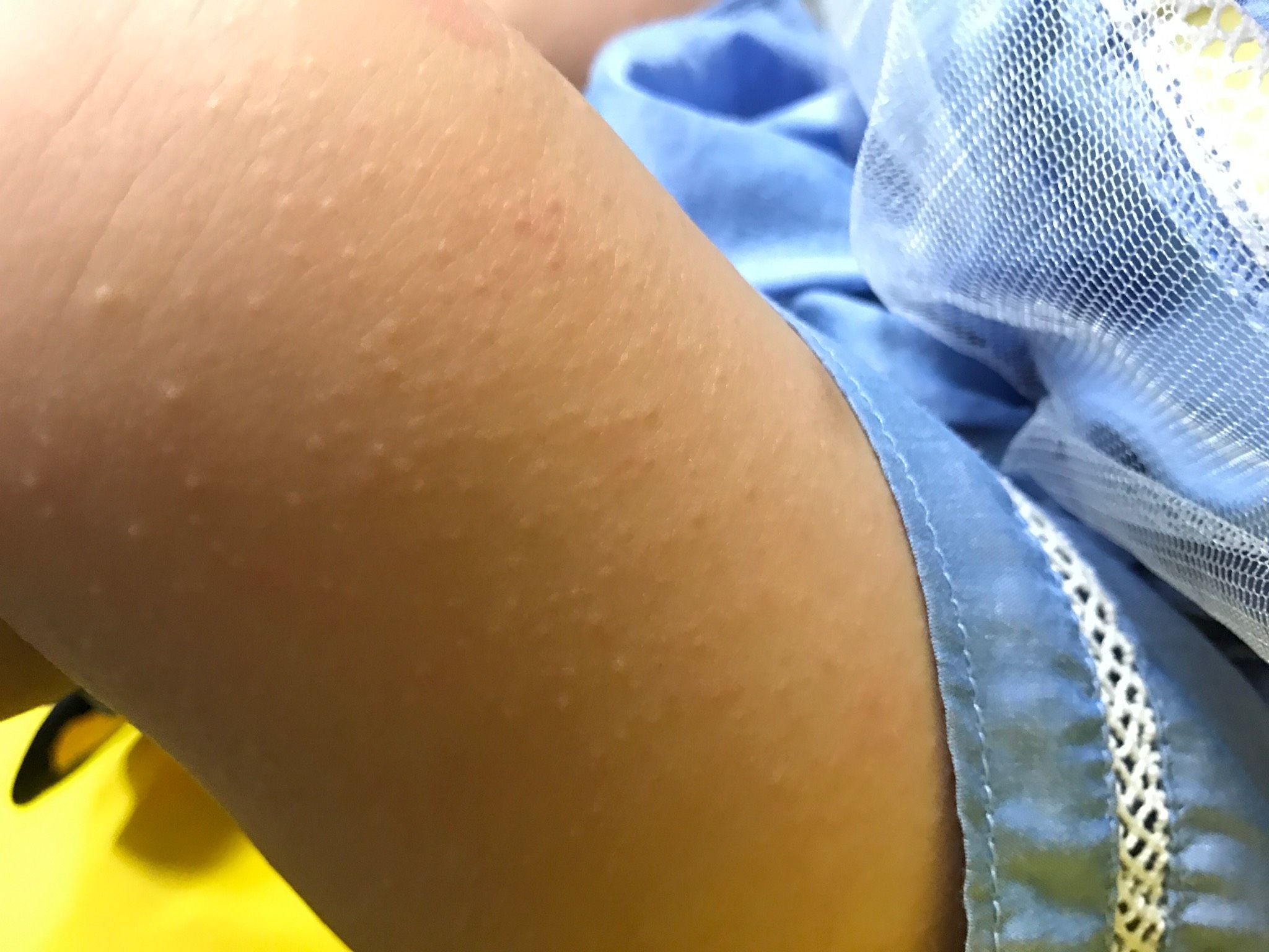 幼兒丘疹性肢端皮膚炎