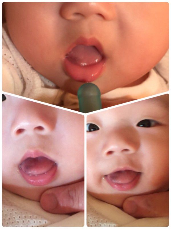 寶寶舌頭黑一塊